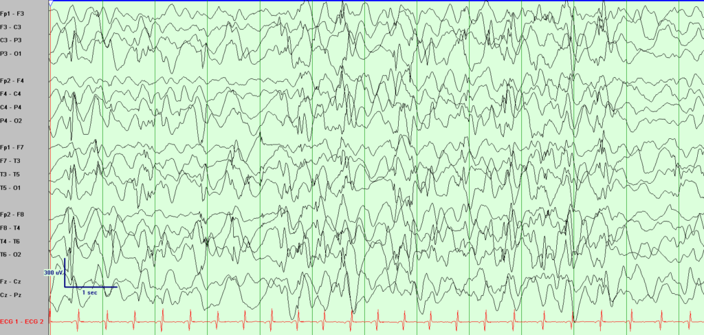 hypsarrhythmia-infantile-spasms-1024x487