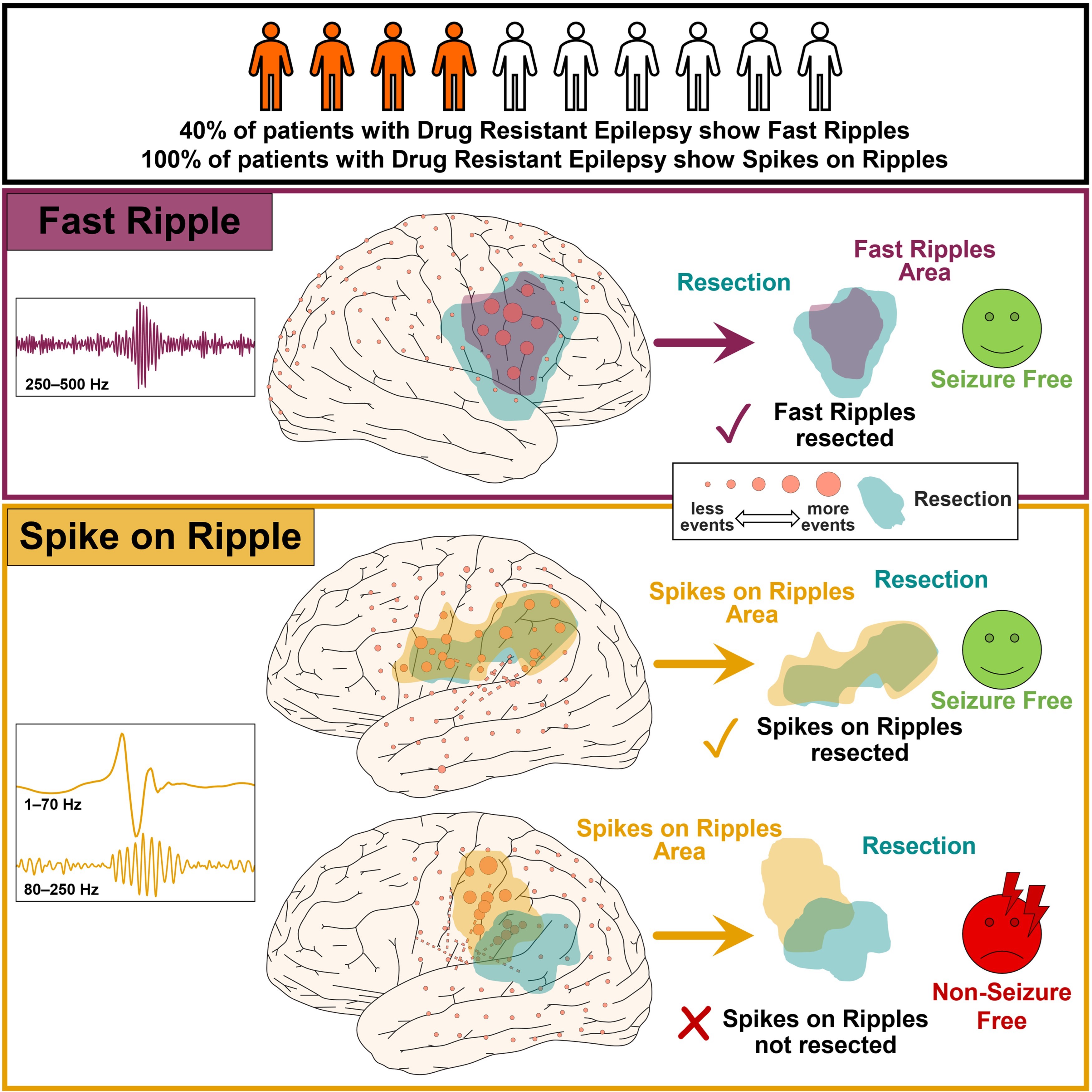 Novel biomarker helps presurgical evaluations in children with drug-resistant epilepsy
